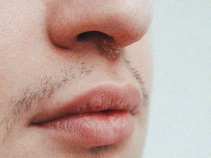 cold sores on lips early stages