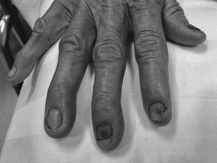 Curved Nails Causes Of Spoon Nails And Curved Tips And Sides