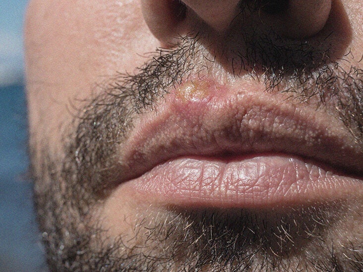 clear bump inside lip cause