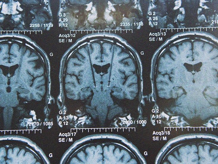 Personalized Brain Stimulation Lifts A Patient S Depression
