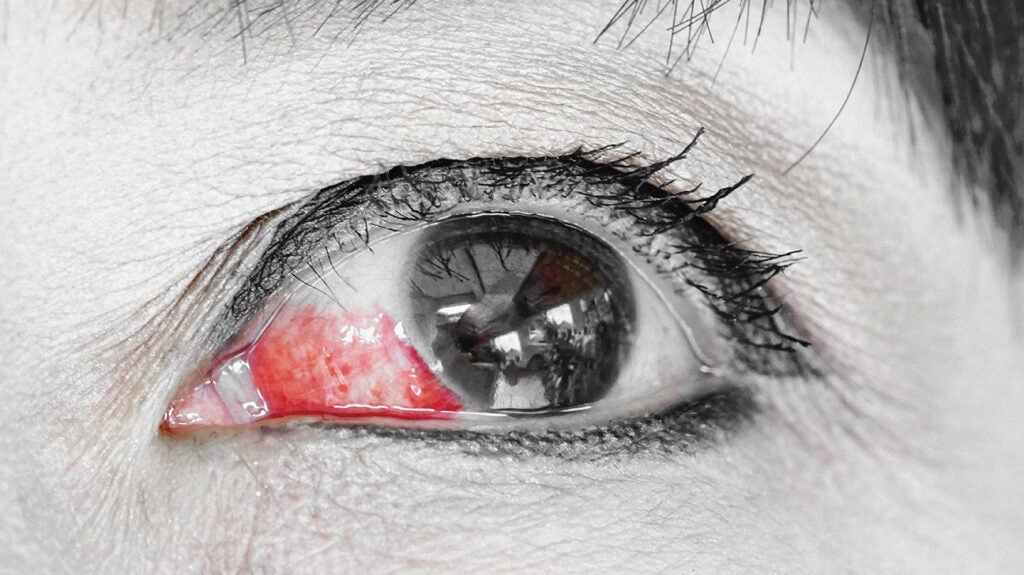 How to Detect Eye Cancer & How to Treat It