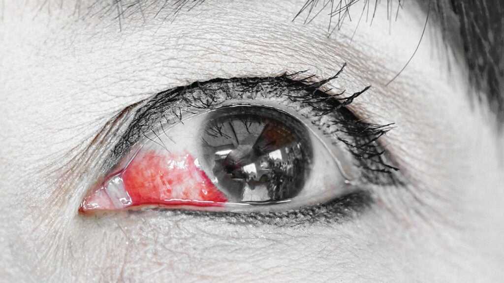 Eye Bleeding Types Causes Treatment And Seeking Help