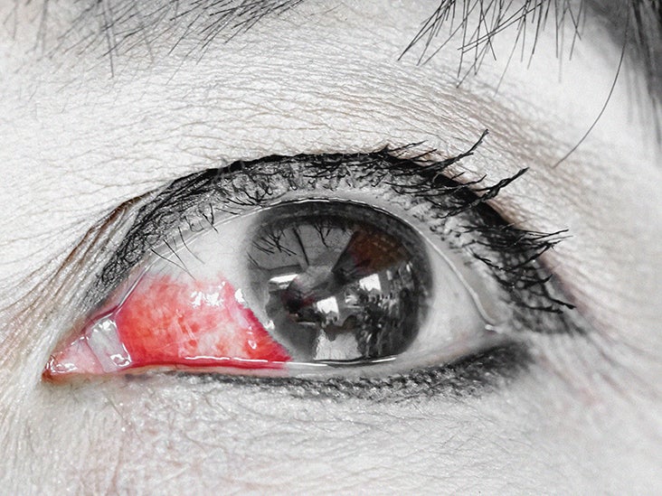 anemia symptoms eye