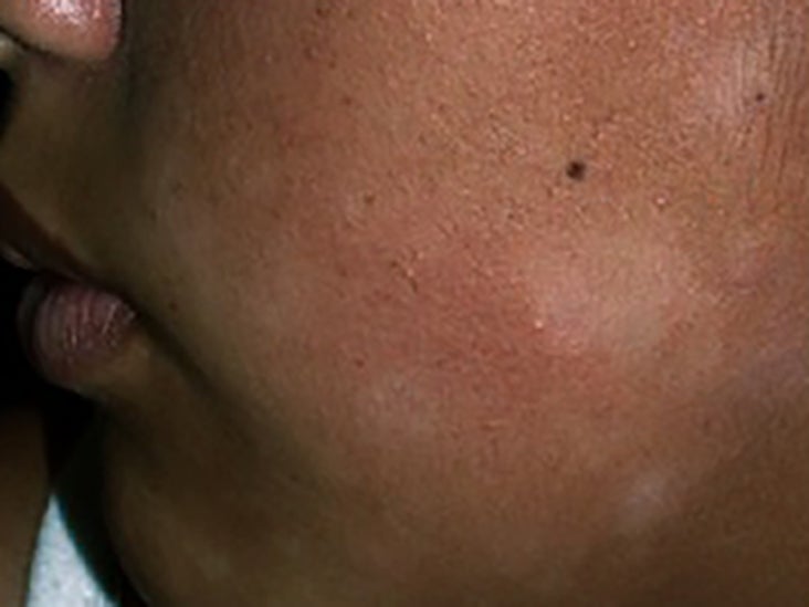 pityriasis-alba-causes-symptoms-and-treatment