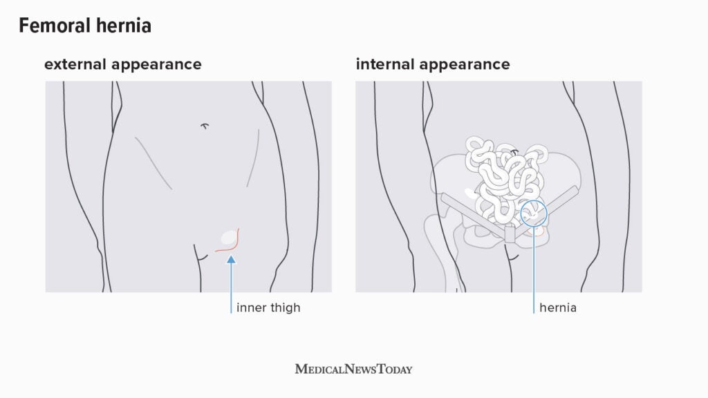Hernia pictures: A visual guide to different hernia types