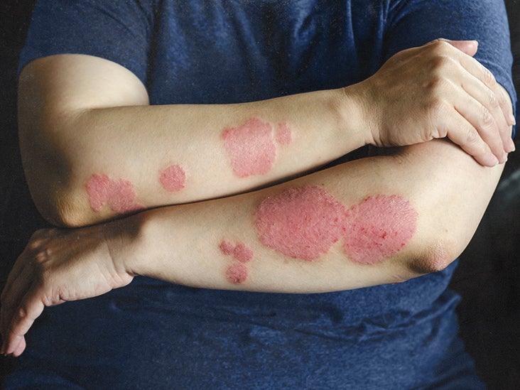 is psoriasis cause by stress