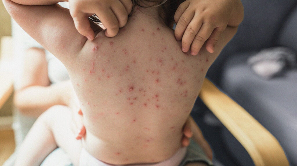 Upper back of young woman contracted chickenpox and red rash