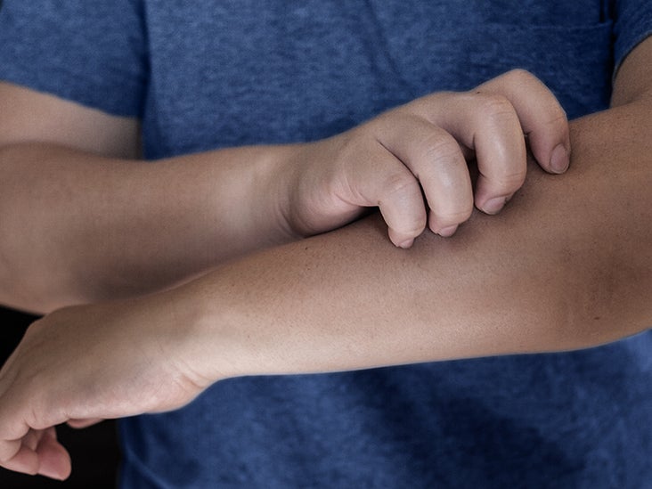 Psoriatic treatment 