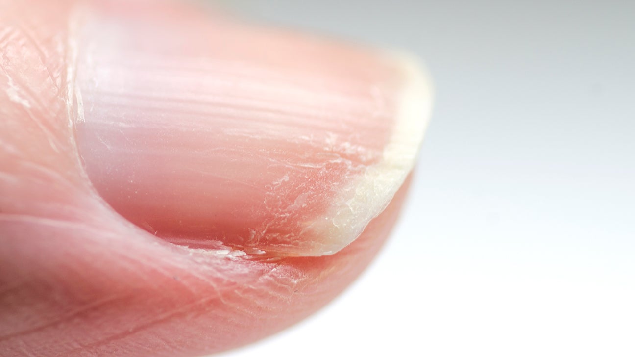 Curved nails: Causes of spoon nails and curved tips and sides
