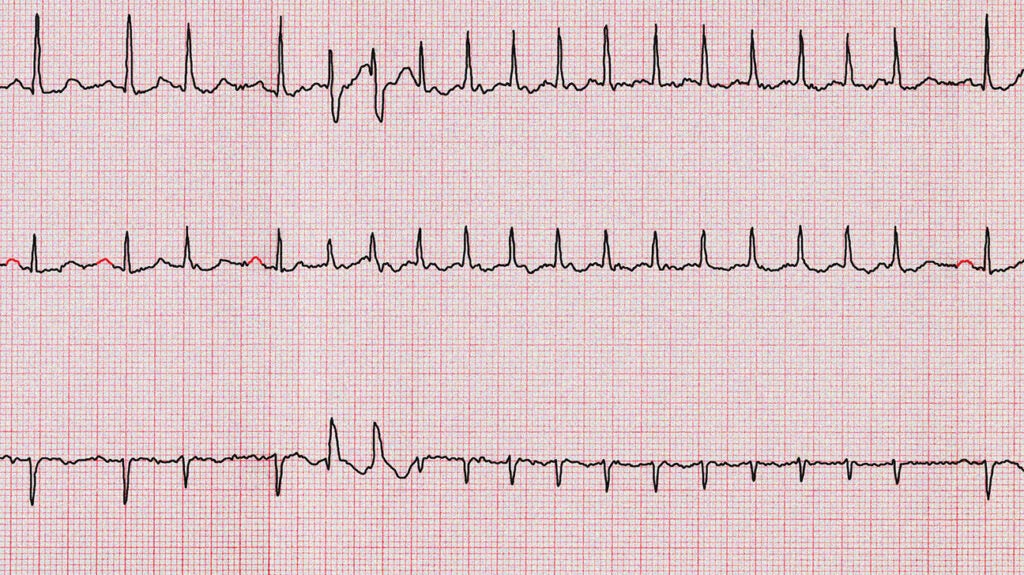 Heart palpitations: Causes, tests, and treatment