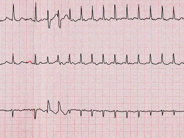 Sinus Arrhythmia Definition Signs And Diagnosis