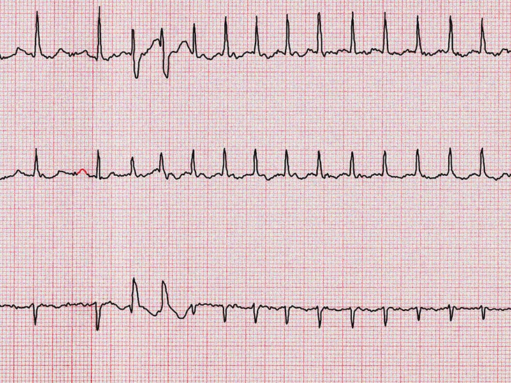 can low blood sugar cause irregular heartbeat)