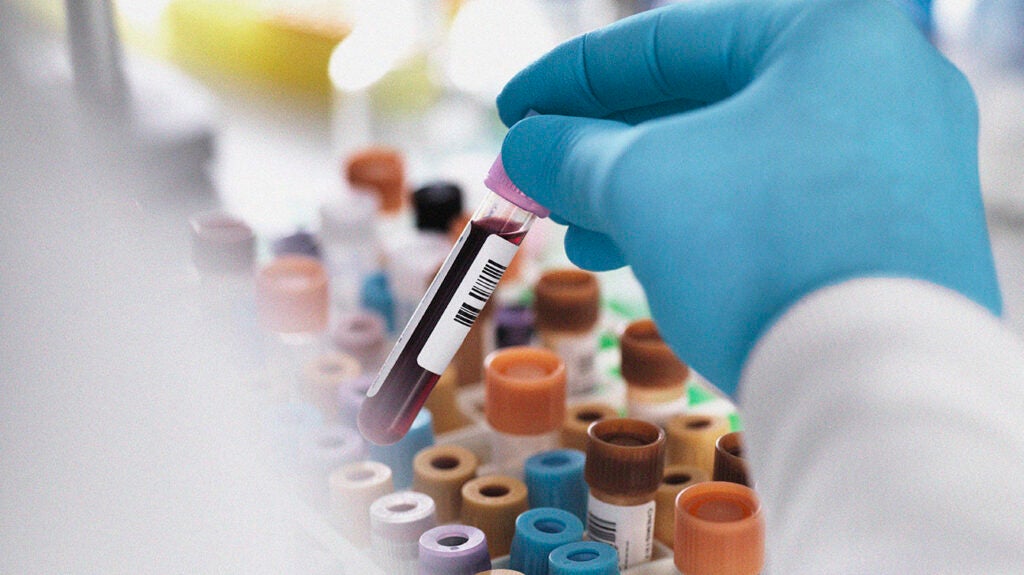 HDL levels: Healthy ranges of 'good' cholesterol and how to raise it
