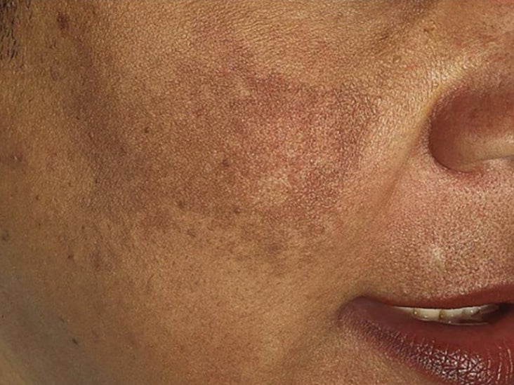 Melasma On Black Skin Causes Treatment And More