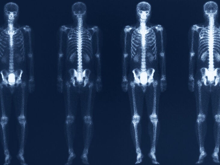 DEXA Scan: What It Is and Why It's Done