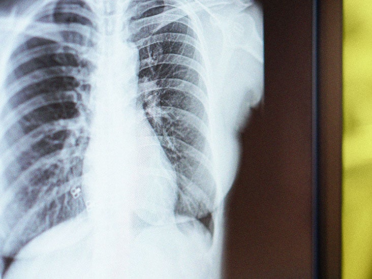Stage 3 Lung Cancer Survival Rate Prognosis And More