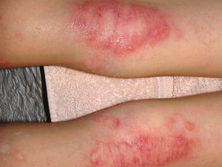 Eczema Rash On Legs Treatment 