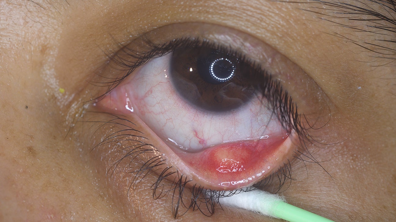 Gritty eyes Causes symptoms treatments and more