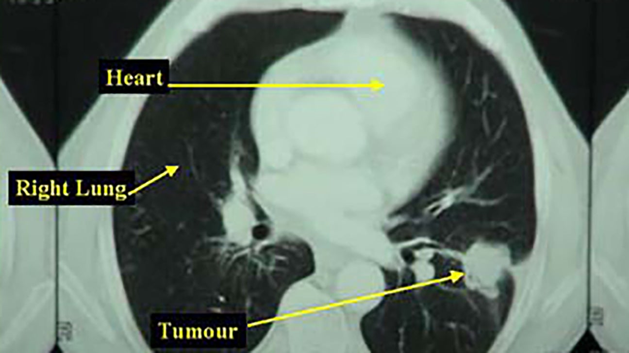 can a lung tumors be benign