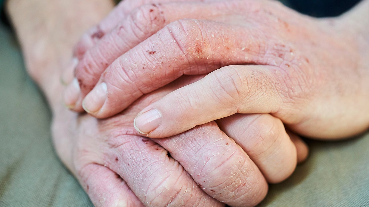 warts on hands eczema