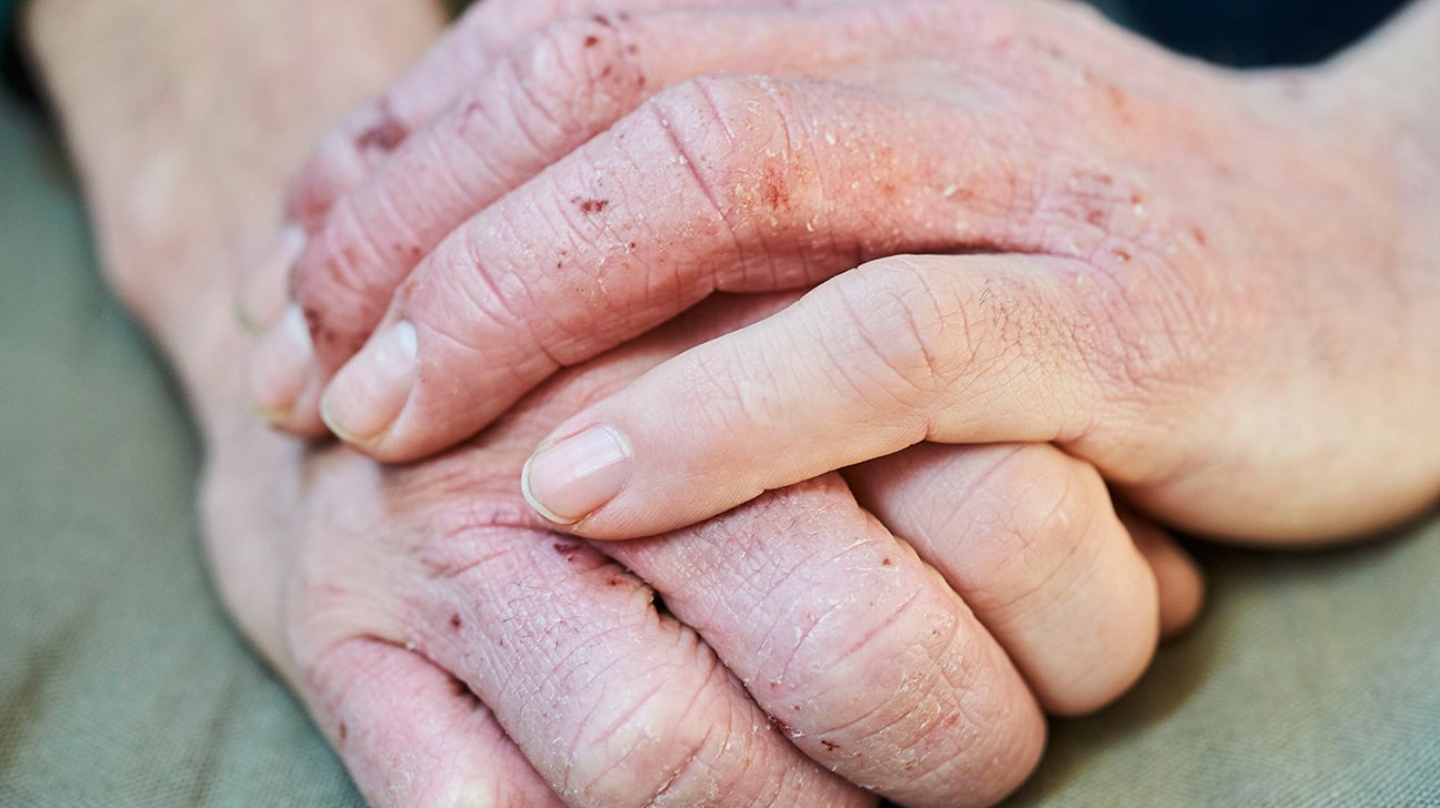 What Causes Eczema On Your Hands And How To Treat It - Bodewell