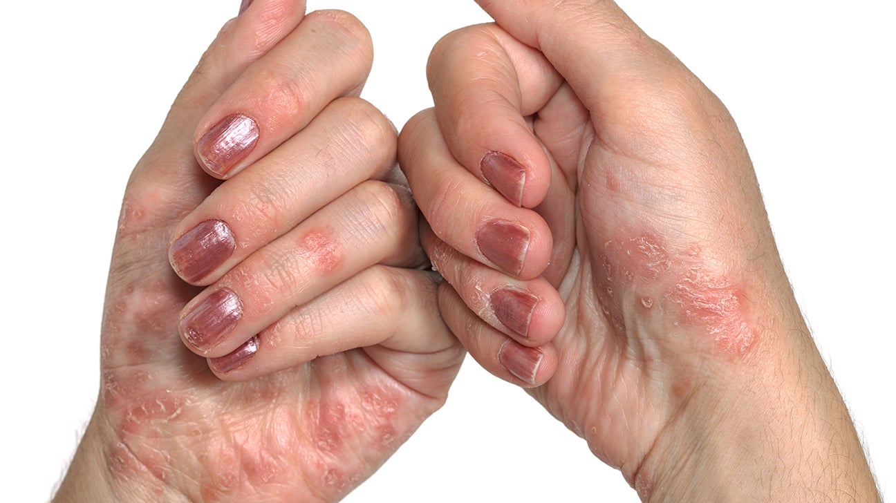 cream for psoriasis on hands