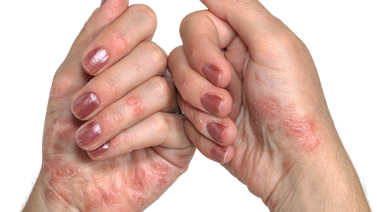 mild psoriasis hands