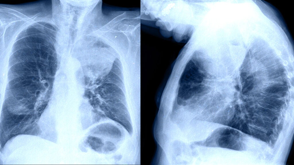 How Long Lung Cancer Spread