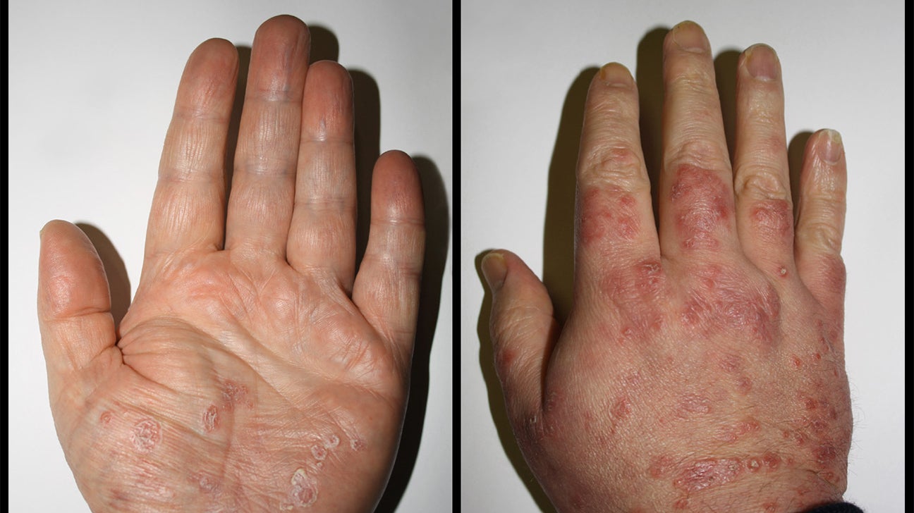 Psoriasis peeling skin on hands