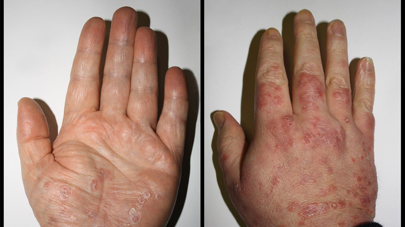 hogyan kezelje a kezén lévő vörös foltokat apakah psoriasis bisa sembuh total