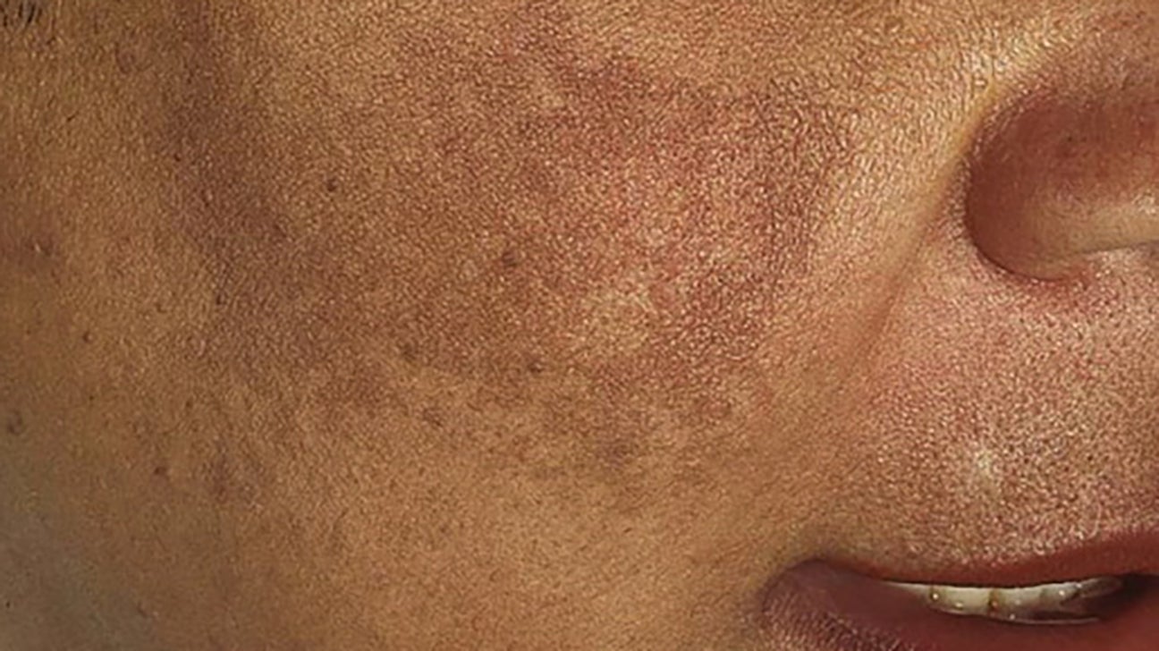 Melasma on black skin Causes, treatment, and more