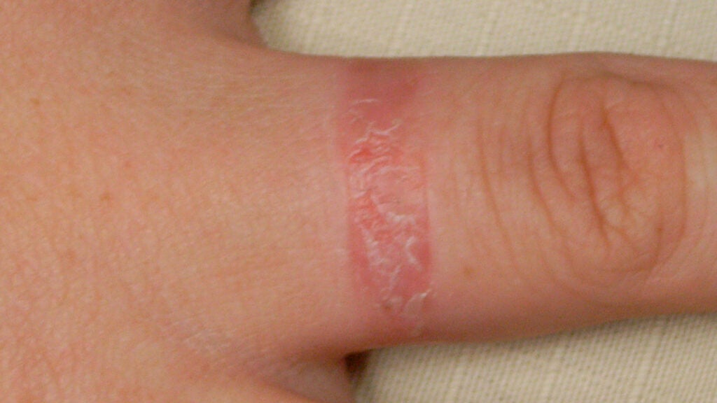 Ring rash Causes, symptoms, and treatment