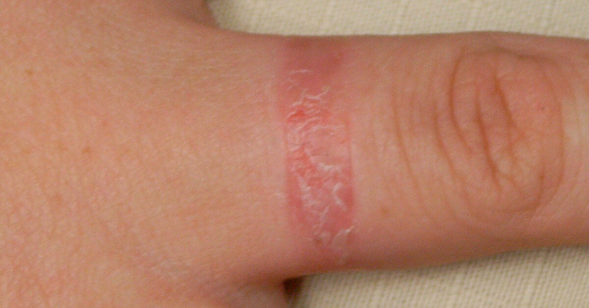 Ring rash Causes, symptoms, and treatment Medical News Today