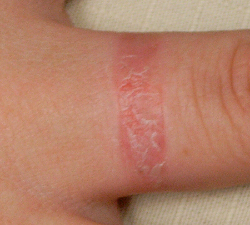 ring-rash-causes-symptoms-and-treatment