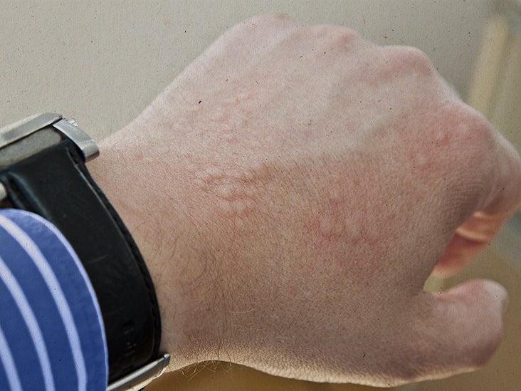 skin pinpoint red spots scabies rash