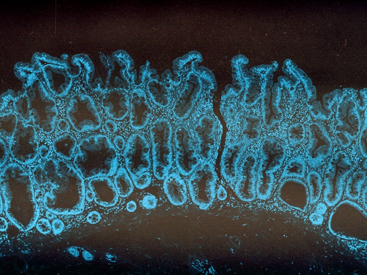 what is an adenoma polyp