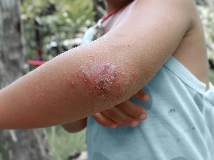 Eczema scars: Causes, treatment, and prevention