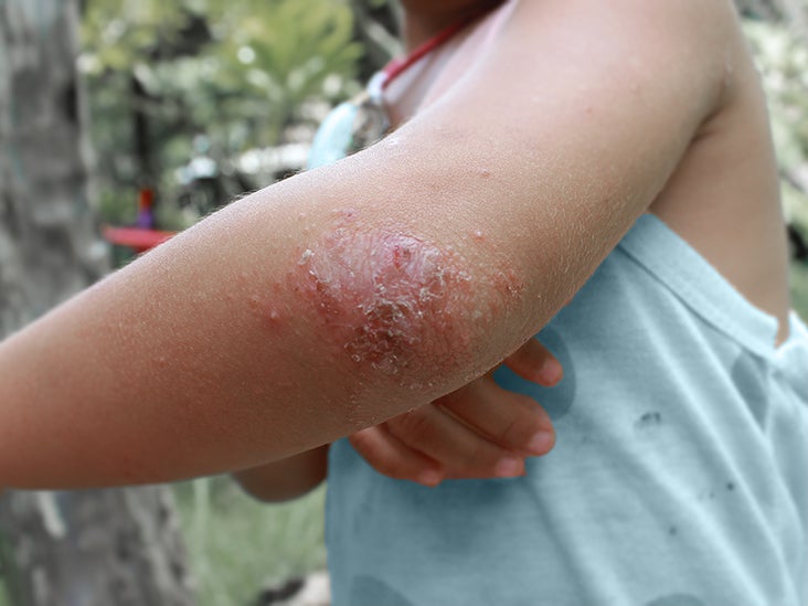 Dyshidrotic Eczema Arms