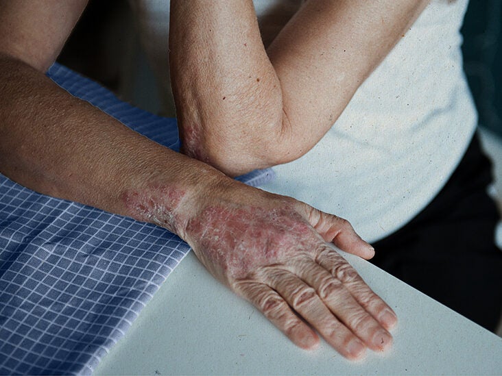 mild psoriasis on hands