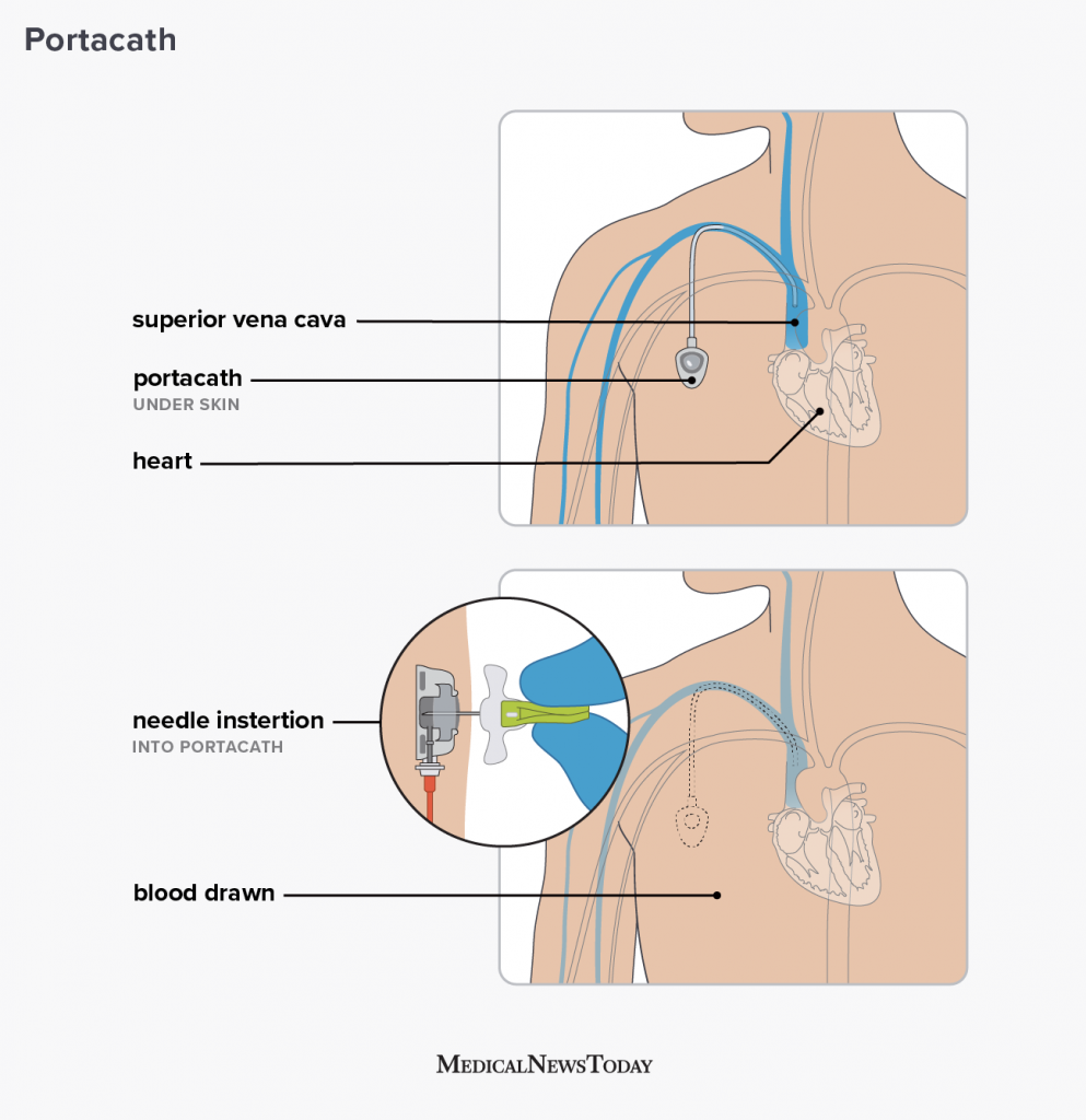 Chemoport Insertion Procedure, Cost, and Complications Explained