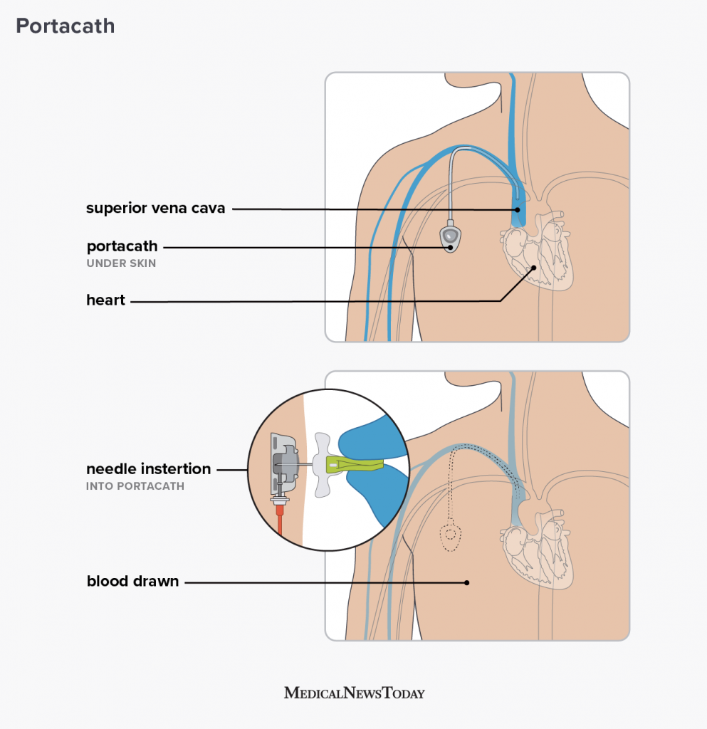 Portacath What Is It Why Is It Used And More Portacath What Is It Why Is It Used And More