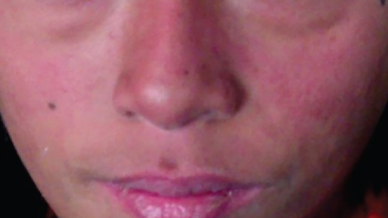 Redness around nose: Causes, treatment, home and