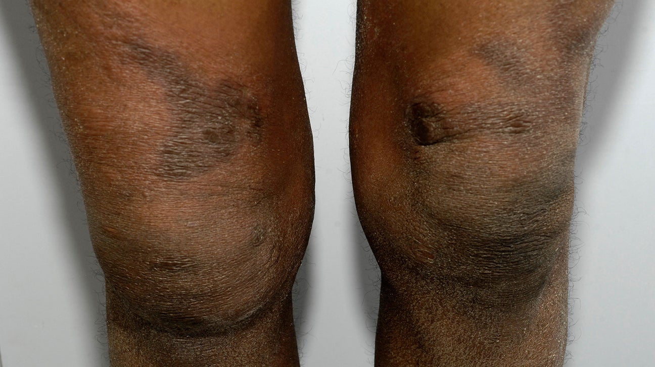 eczema vs psoriasis vörös folt a bőrön mint kezelni