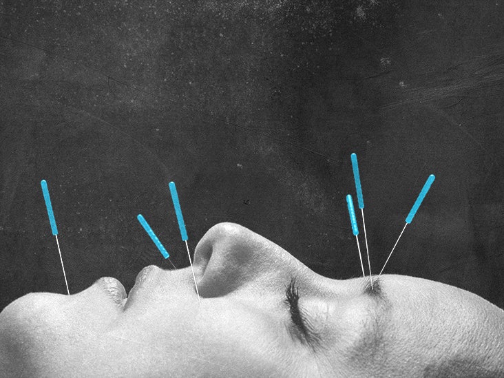 Acupuncture for migraine What to know