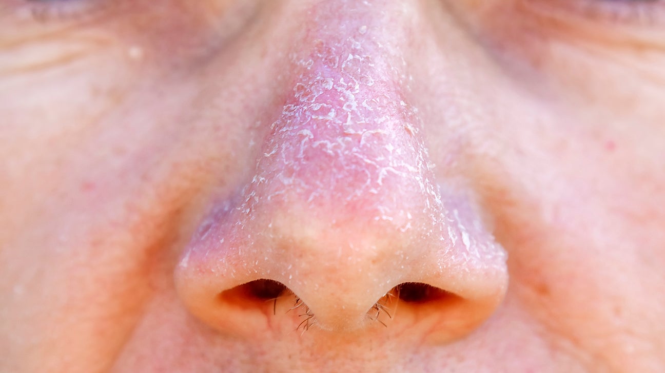 Redness around nose: Causes, treatment, home and