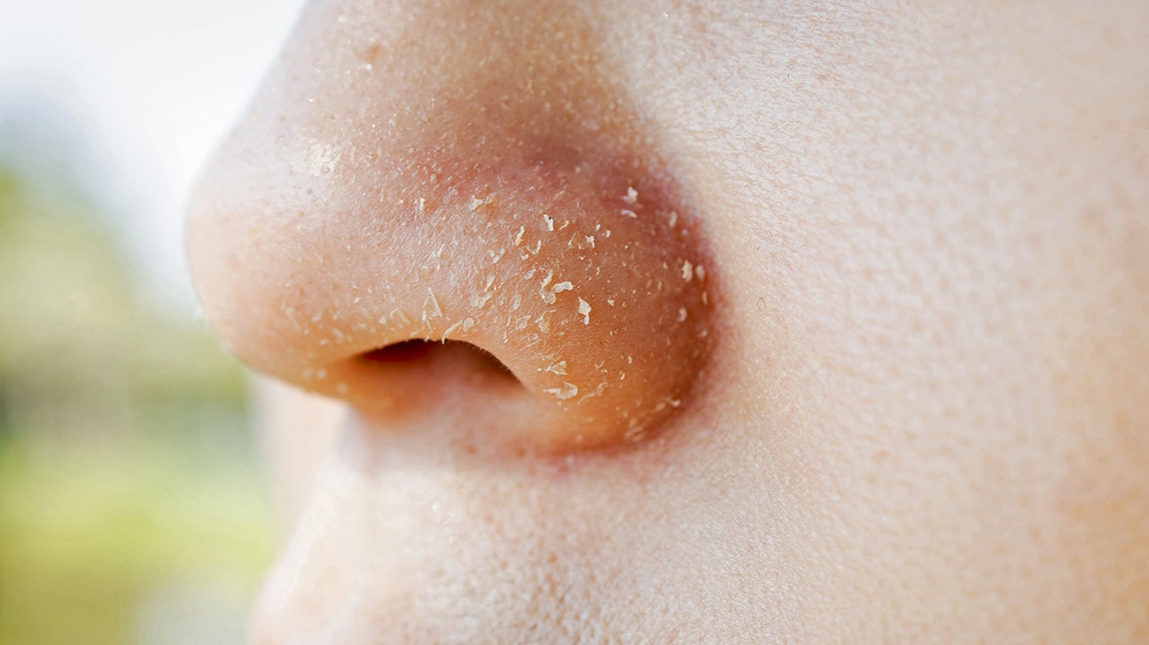 How To Remove Dry Flaky Skin From Nose At Joel Kates Blog