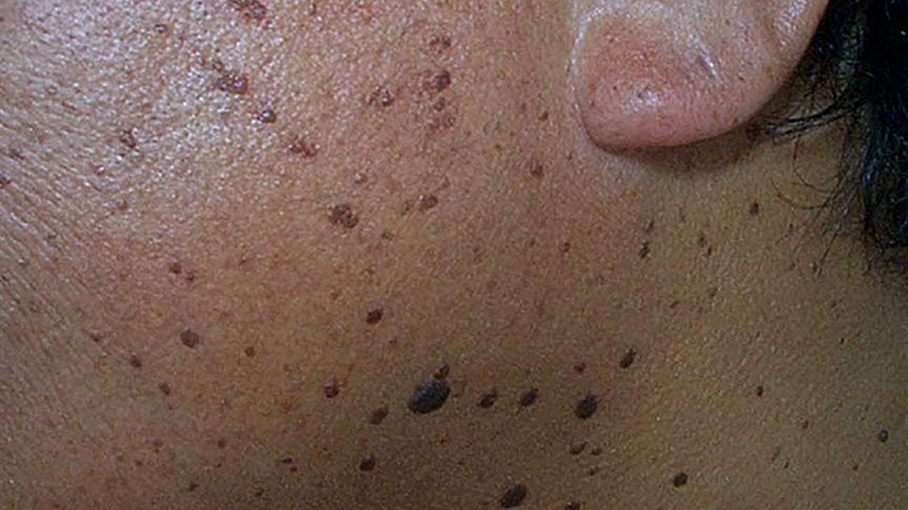 Skin conditions in black skin: Symptoms and treatment, image size:1296x728