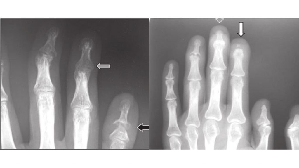 What to know about pencilincup deformity