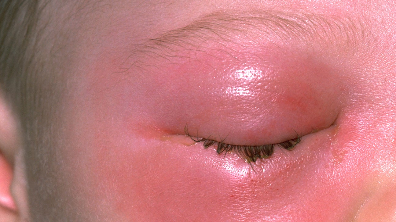 Differential Diagnosis For Periorbital Cellulitis At Sandra Slavin Blog Differential Diagnosis For Periorbital Cellulitis At Sandra Slavin Blog