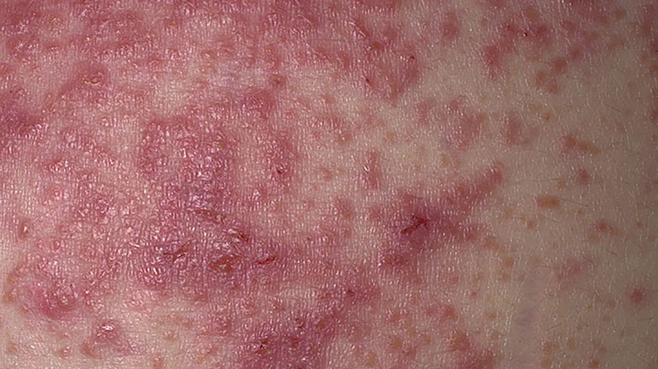 Just wondering, but do these look like scabies marks to you